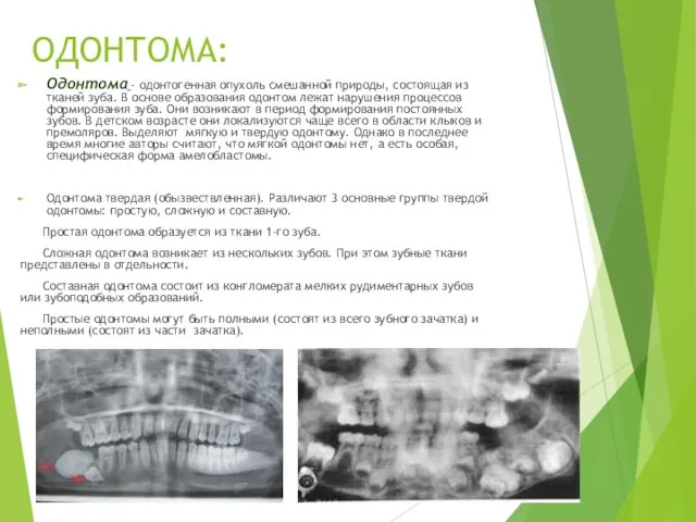 ОДОНТОМА: Одонтома - одонтогенная опухоль смешанной природы, состоящая из тканей