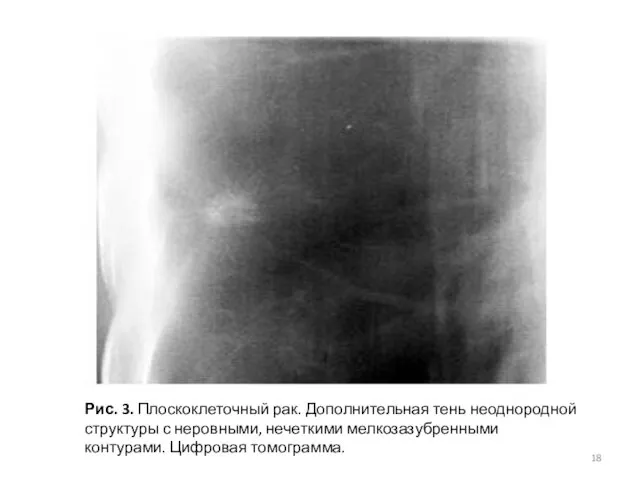 Рис. 3. Плоскоклеточный рак. Дополнительная тень неоднородной структуры с неровными, нечеткими мелкозазубренными контурами. Цифровая томограмма.