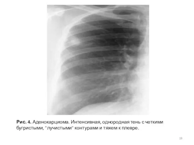 Рис. 4. Аденокарциома. Интенсивная, однородная тень с четкими бугристыми, "лучистыми" контурами и тяжем к плевре.