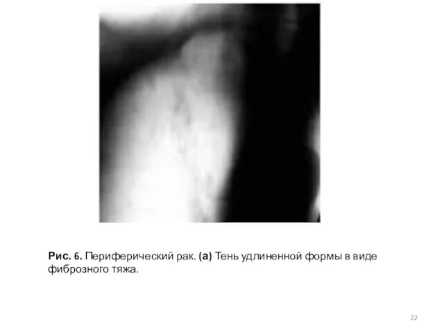 Рис. 6. Периферический рак. (а) Тень удлиненной формы в виде фиброзного тяжа.