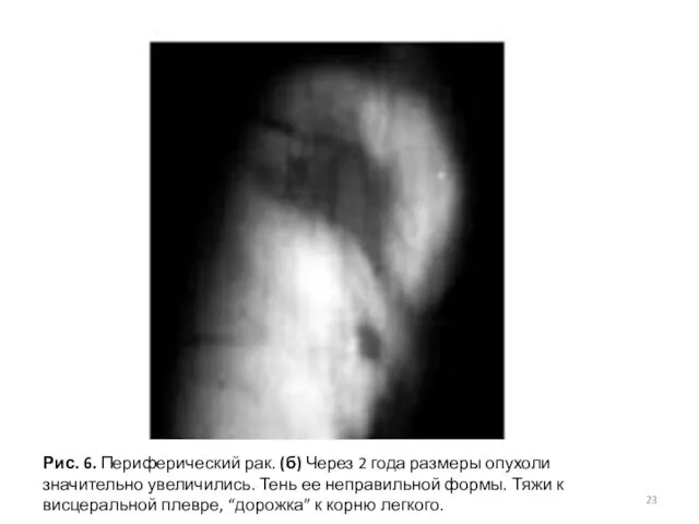 Рис. 6. Периферический рак. (б) Через 2 года размеры опухоли