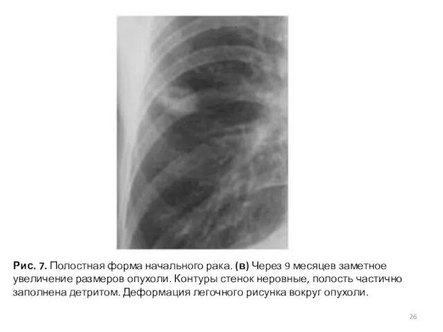 Рис. 7. Полостная форма начального рака. (в) Через 9 месяцев