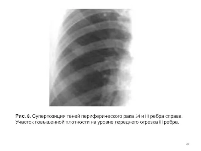 Рис. 8. Суперпозиция теней периферического рака S4 и III ребра