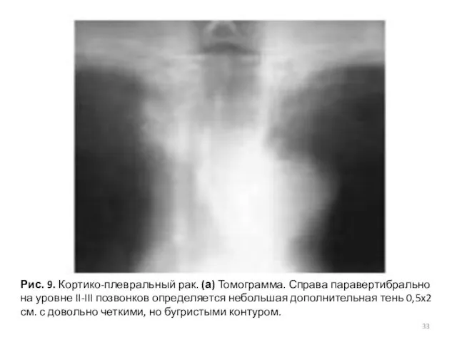 Рис. 9. Кортико-плевральный рак. (а) Томограмма. Справа паравертибрально на уровне