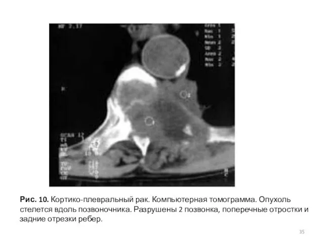 Рис. 10. Кортико-плевральный рак. Компьютерная томограмма. Опухоль стелется вдоль позвоночника.