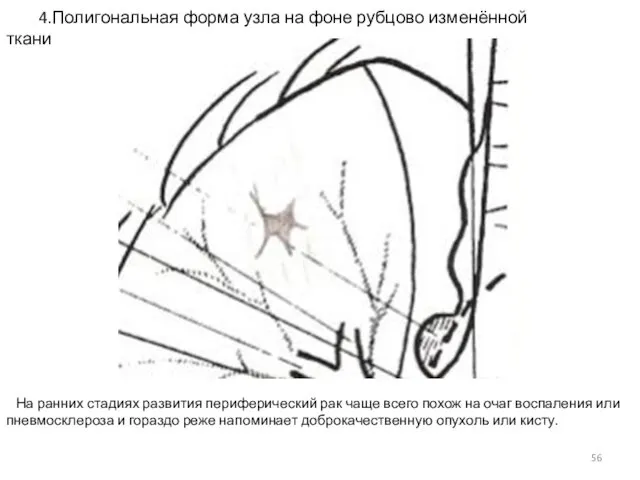 4.Полигональная форма узла на фоне рубцово изменённой ткани На ранних