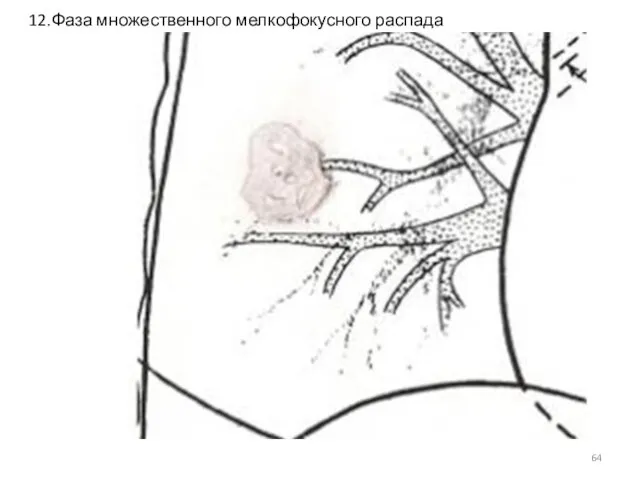 12.Фаза множественного мелкофокусного распада