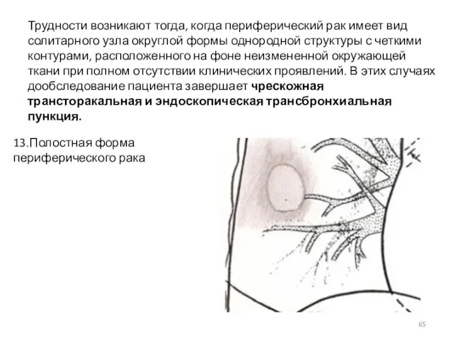 Трудности возникают тогда, когда периферический рак имеет вид солитарного узла