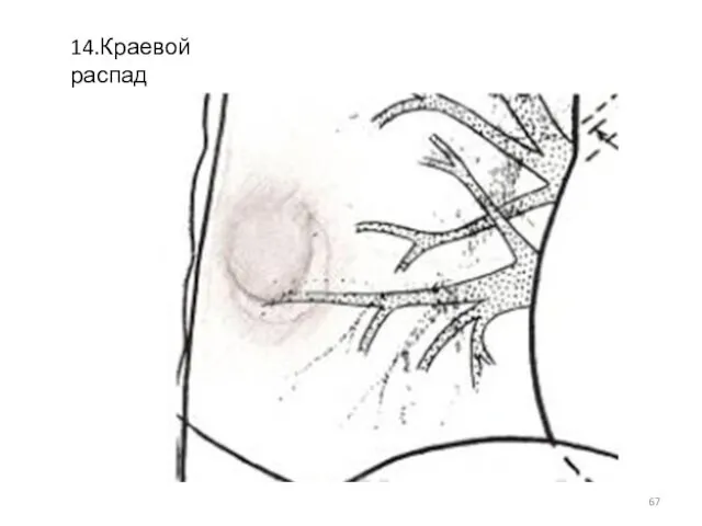 14.Краевой распад