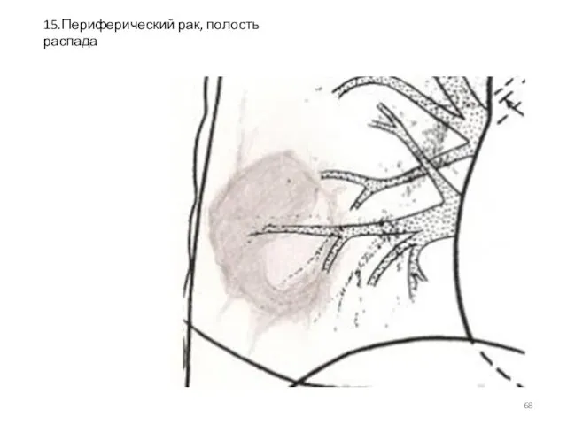 15.Периферический рак, полость распада