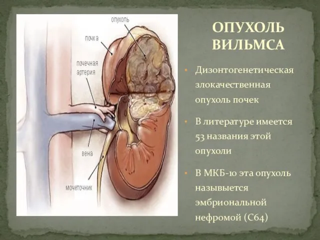 Дизонтогенетическая злокачественная опухоль почек В литературе имеется 53 названия этой