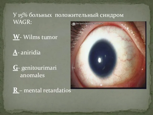 У 15% больных положительный синдром WAGR: W- Wilms tumor A- aniridia G- genitourimari