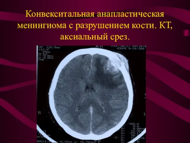 Конвекситальная анапластическая менингиома с разрушением кости. КТ, аксиальный срез.