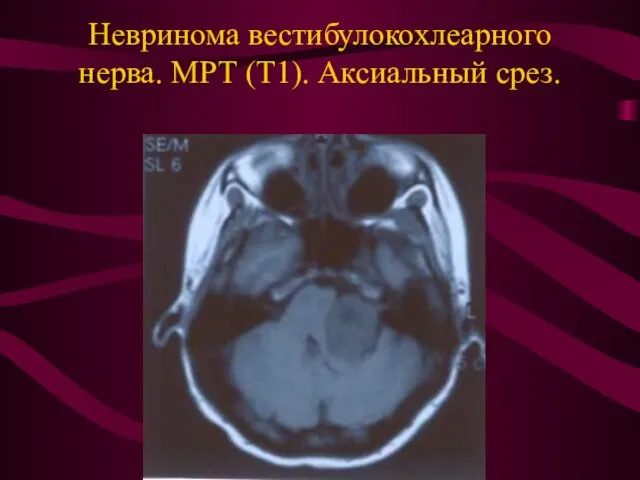 Невринома вестибулокохлеарного нерва. МРТ (Т1). Аксиальный срез.