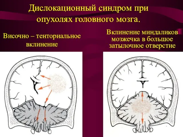 Дислокационный синдром при опухолях головного мозга. Височно – тенториальное вклинение