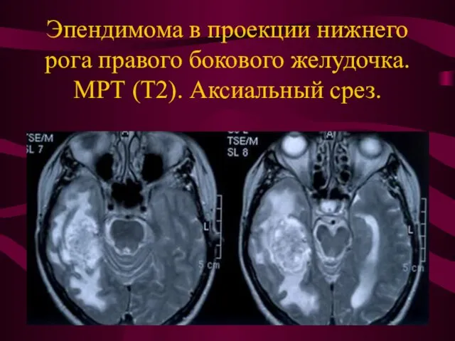 Эпендимома в проекции нижнего рога правого бокового желудочка. МРТ (Т2). Аксиальный срез.