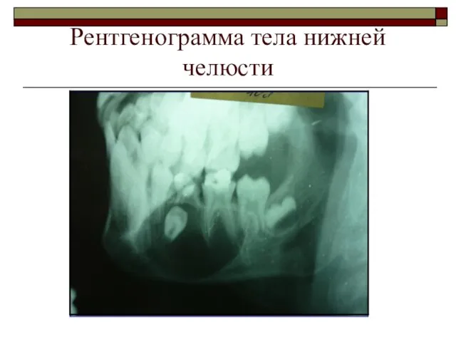 Рентгенограмма тела нижней челюсти