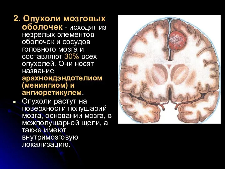 2. Опухоли мозговых оболочек - исходят из незрелых элементов оболочек и сосудов головного