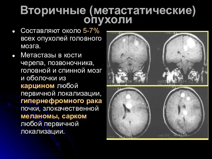 Вторичные (метастатические) опухоли Составляют около 5-7% всех опухолей головного мозга. Метастазы в кости
