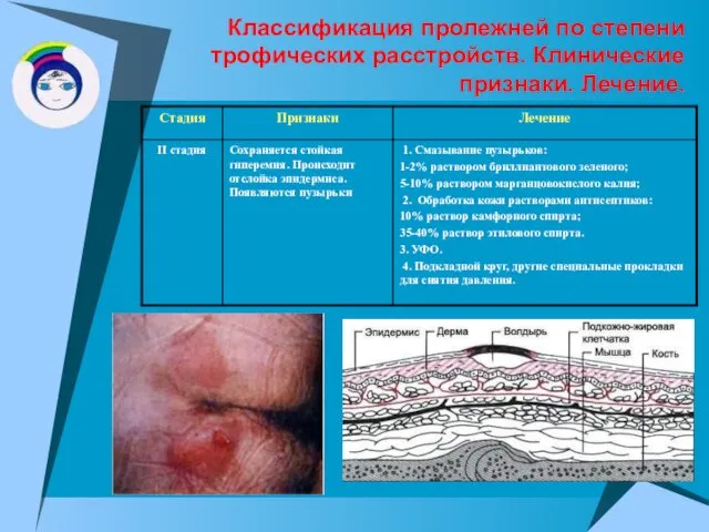 Классификация пролежней по степени трофических расстройств. Клинические признаки. Лечение.