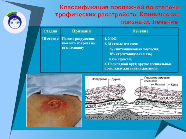 Классификация пролежней по степени трофических расстройств. Клинические признаки. Лечение.