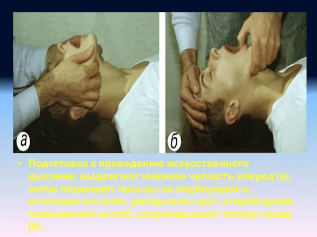 Подготовка к проведению искусственного дыхания: выдвигают нижнюю челюсть вперед (а), затем переводят пальцы