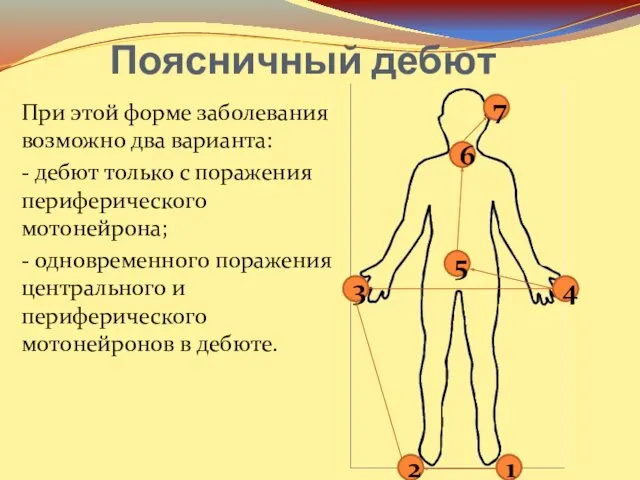 Поясничный дебют При этой форме заболевания возможно два варианта: -