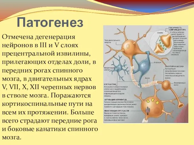 Патогенез Отмечена дегенерация нейронов в III и V слоях прецентральной