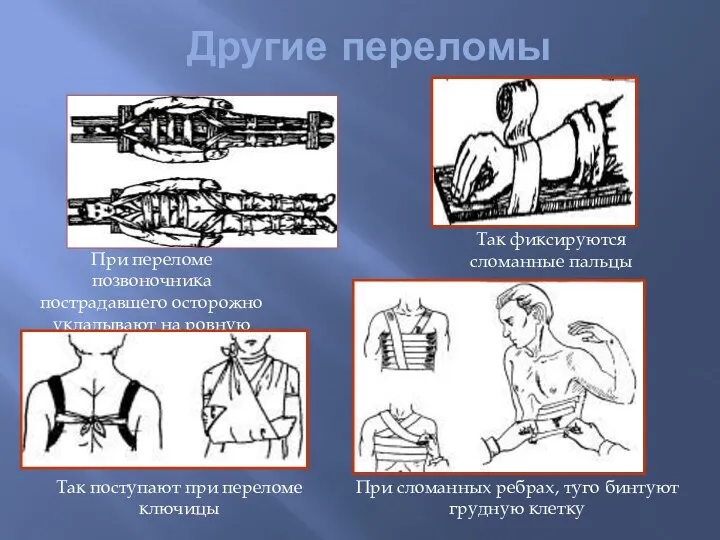 Другие переломы При переломе позвоночника пострадавшего осторожно укладывают на ровную