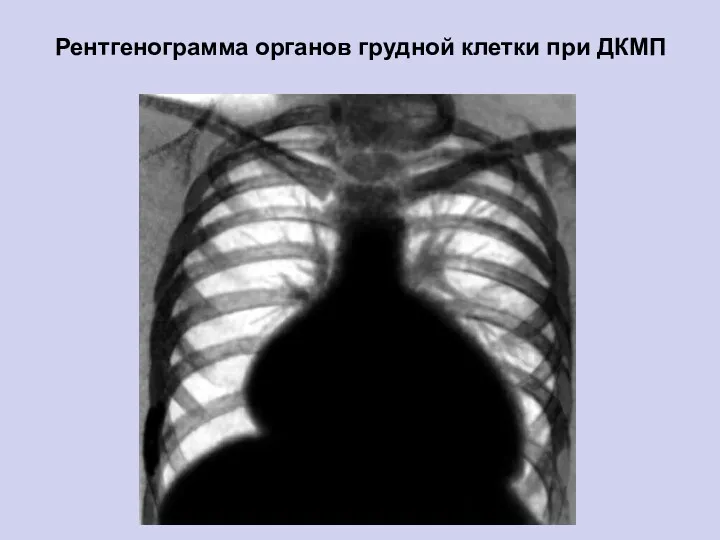 Рентгенограмма органов грудной клетки при ДКМП