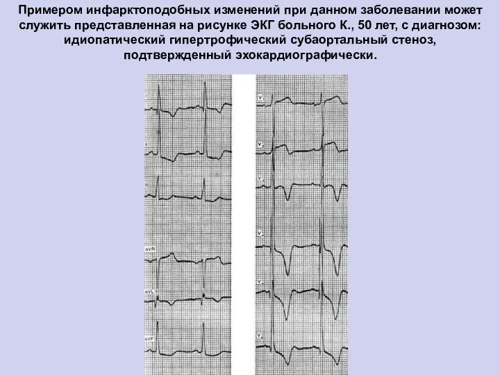 Примером инфарктоподобных изменений при данном заболевании может служить представленная на рисунке ЭКГ больного