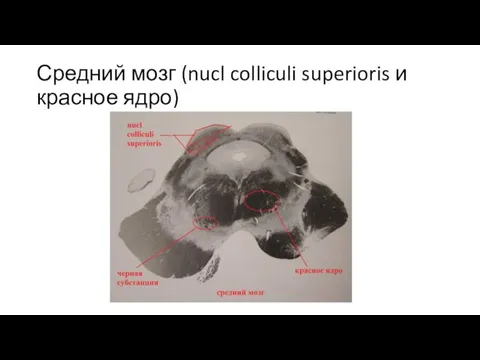 Средний мозг (nucl colliculi superioris и красное ядро)