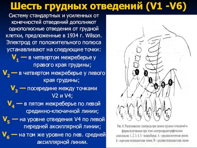 Шесть грудных отведений (V1 -V6) Систему стандартных и усиленных от