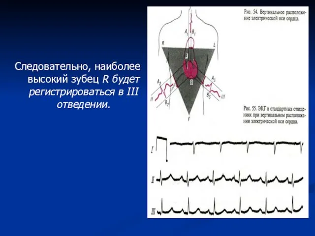 Следовательно, наиболее высокий зубец R будет регистрироваться в III отведении.