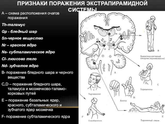 ПРИЗНАКИ ПОРАЖЕНИЯ ЭКСТРАПИРАМИДНОЙ СИСТЕМЫ А – схема расположения очагов поражения