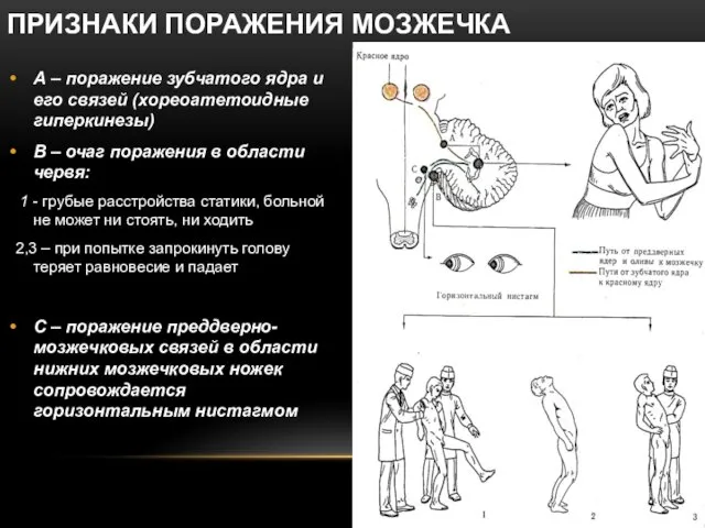 ПРИЗНАКИ ПОРАЖЕНИЯ МОЗЖЕЧКА А – поражение зубчатого ядра и его