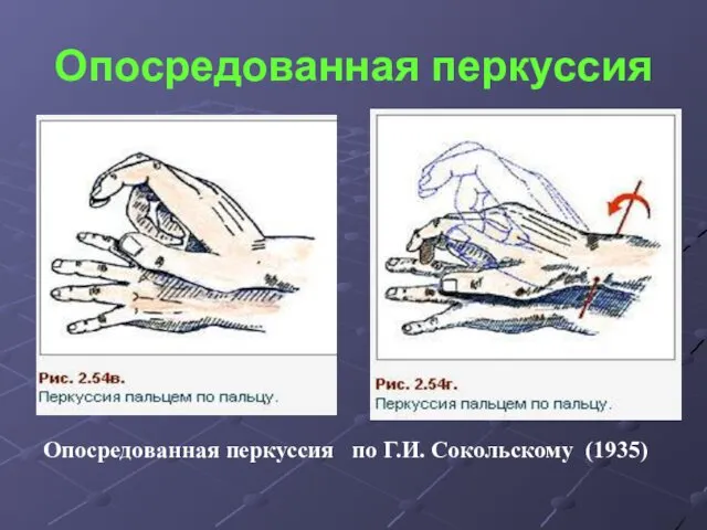 Опосредованная перкуссия Опосредованная перкуссия по Г.И. Сокольскому (1935)