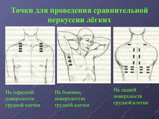 Точки для проведения сравнительной перкуссии лёгких На передней поверхности грудной