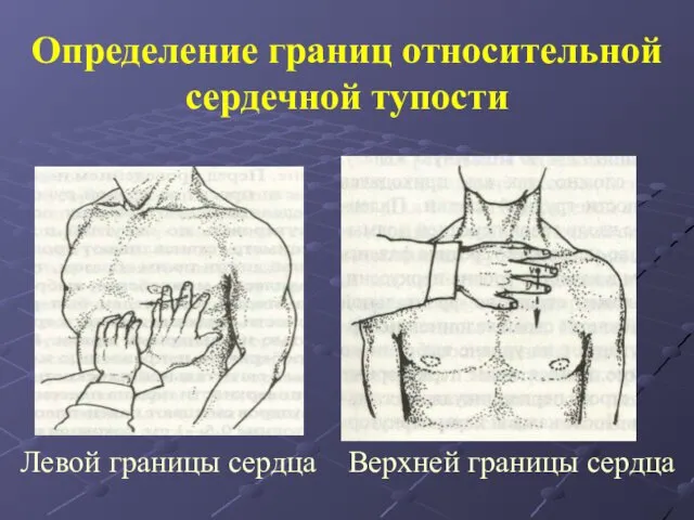 Определение границ относительной сердечной тупости Левой границы сердца Верхней границы сердца