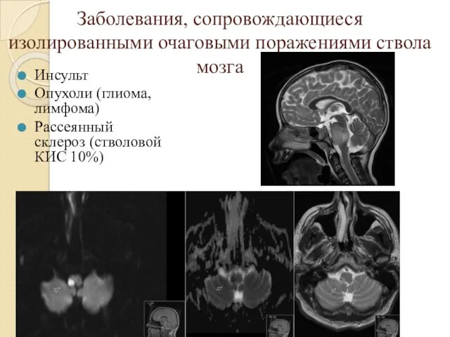 Заболевания, сопровождающиеся изолированными очаговыми поражениями ствола мозга Инсульт Опухоли (глиома, лимфома) Рассеянный склероз (стволовой КИС 10%)