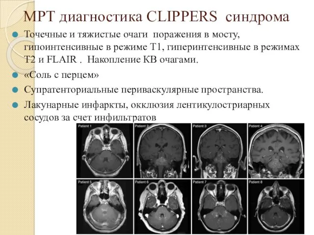 МРТ диагностика CLIPPERS синдрома Точечные и тяжистые очаги поражения в мосту, гипоинтенсивные в