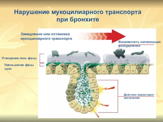 Нарушение мукоцилиарного транспорта при бронхите Утолщение гель фазы Уменьшение фазы