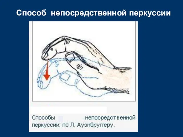 Способ непосредственной перкуссии