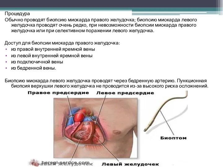 Процедура Обычно проводят биопсию миокарда правого желудочка; биопсию миокарда левого