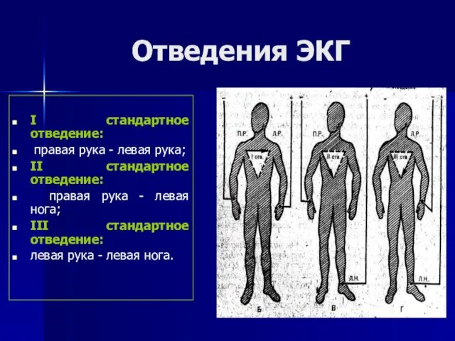 Отведения ЭКГ І стандартное отведение: правая рука - левая рука;