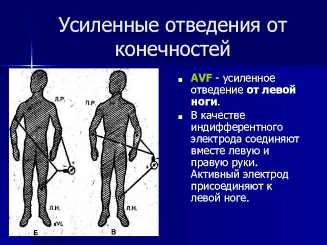 Усиленные отведения от конечностей АVF - усиленное отведение от левой ноги. В качестве