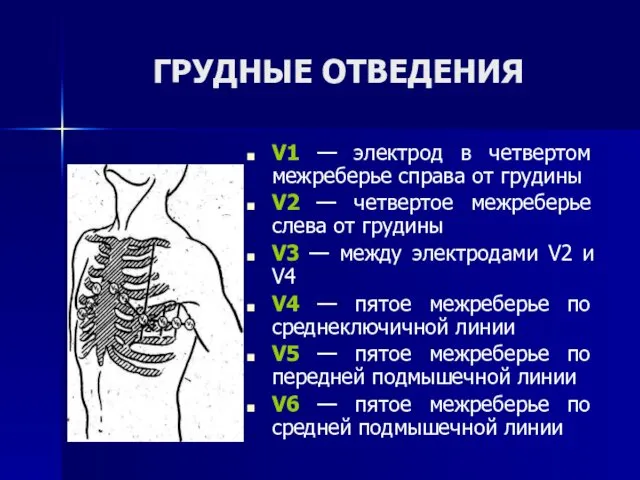 ГРУДНЫЕ ОТВЕДЕНИЯ V1 — электрод в четвертом межреберье справа от