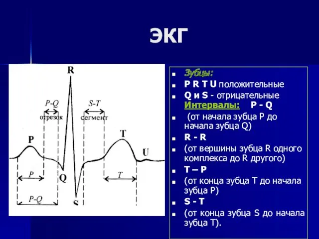 ЭКГ Зубцы: Р R T U положительные Q и S