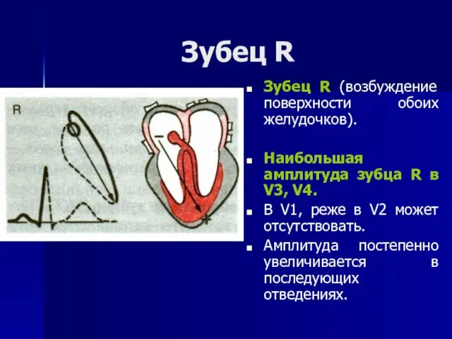 Зубец R Зубец R (возбуждение поверхности обоих желудочков). Наибольшая амплитуда