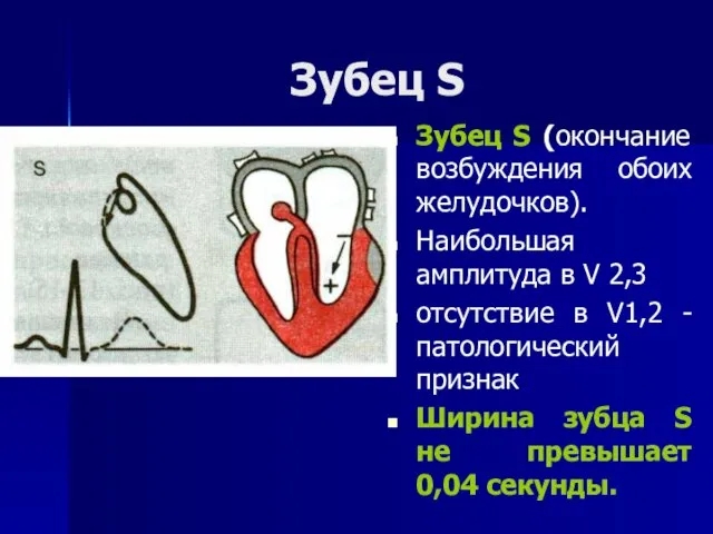 Зубец S Зубец S (окончание возбуждения обоих желудочков). Наибольшая амплитуда